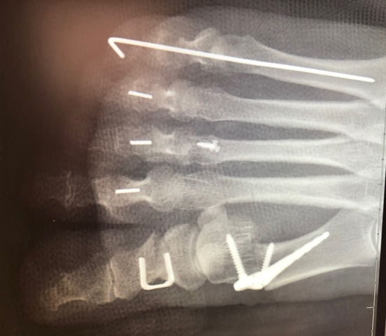 PIPJ arthrodesis of 2nd, 3rd, and 4th ray using the Vector™ Hammertoe Correction System manufactured from PEEK-OPTIMA™ HA Enhanced