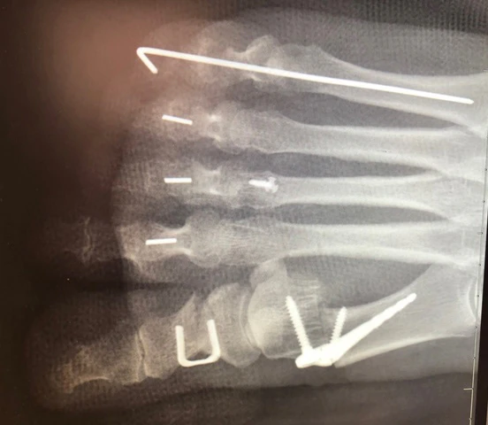 PIPJ arthrodesis of 2nd, 3rd, and 4th ray using the Vector™ Hammertoe Correction System manufactured from PEEK-OPTIMA™ HA Enhanced
