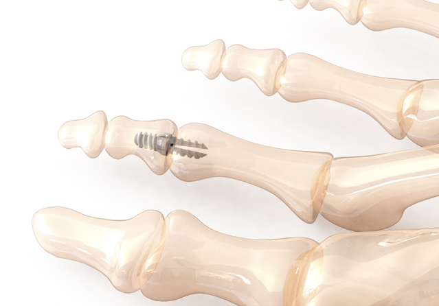 Vector™ Hammertoe Correction System