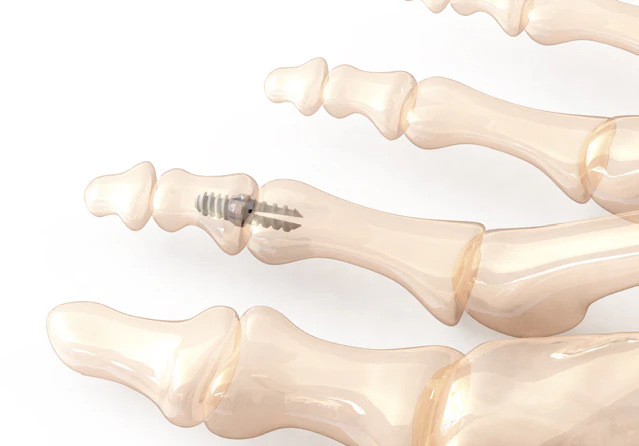 Vector™ Hammertoe Correction System