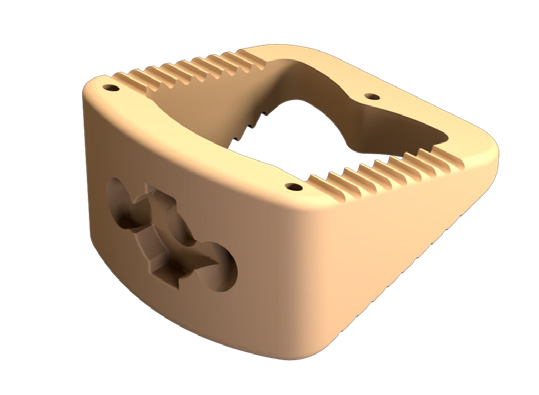 Trigon™ HA Stand-Alone Wedge Fixation System Evans lengthening osteotomies