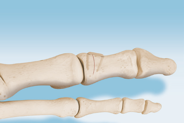 O.S.2®-VP Staple PEEK-OPTIMA Natural osteosynthesis staple