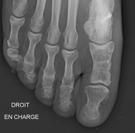 Invibio X-ray of implanted device images