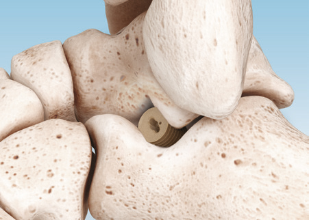 PitStop®Subtalar Implant manufactured from PEEK-OPTIMA™ Natural