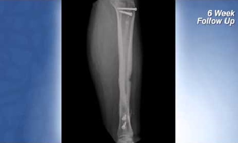 Case Study - Complex Tibia Fracture