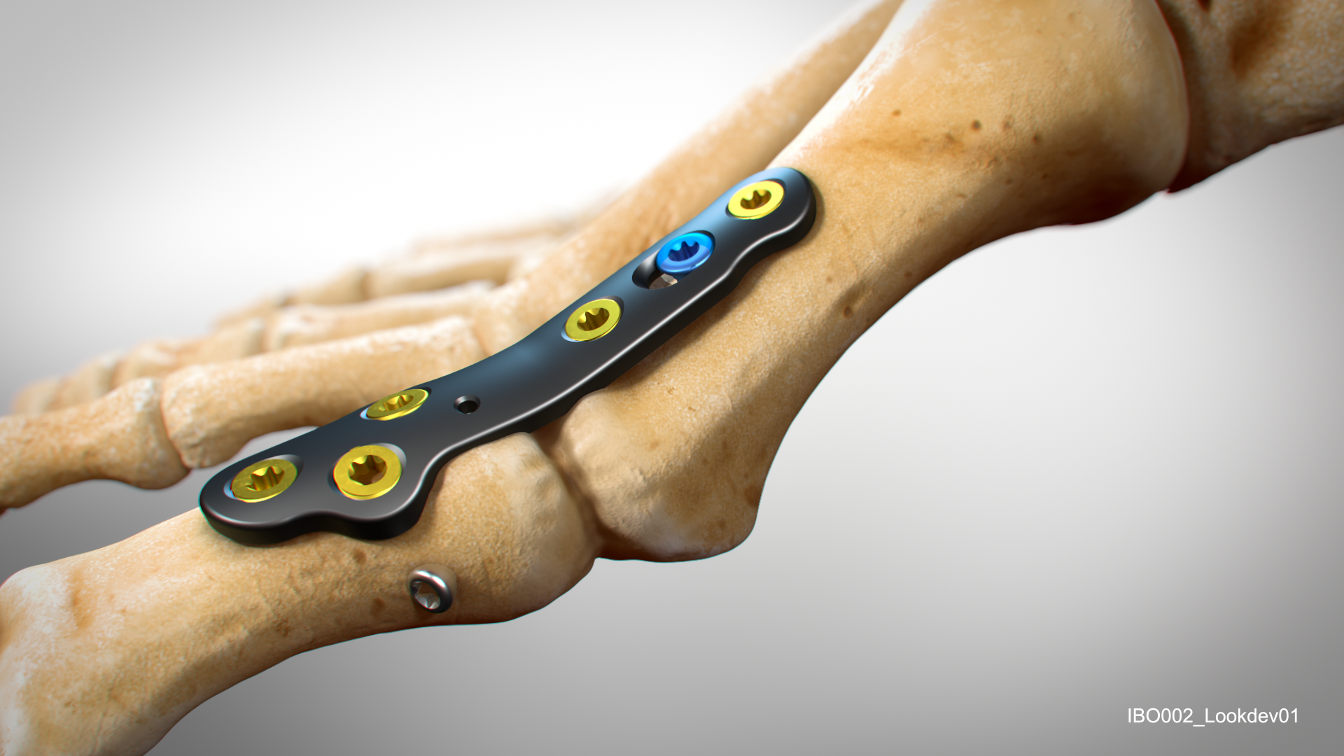 In2Bines CoLink plate on bone 