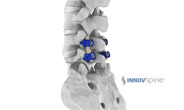 Unid Rods New European approval Semi-rigid spinal rods