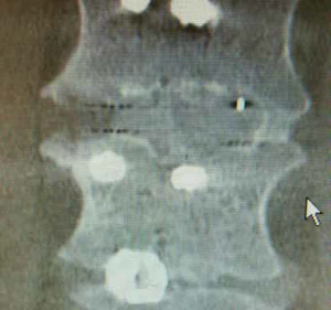 Timothy Bassett Spinal News Xray image