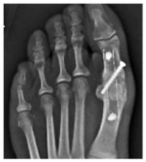 Trauma Xray of a foot implanted with carbon fibre PEEK