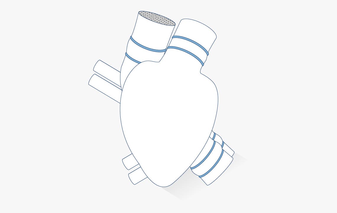 Device Illustrations Artificial heart impeller pump