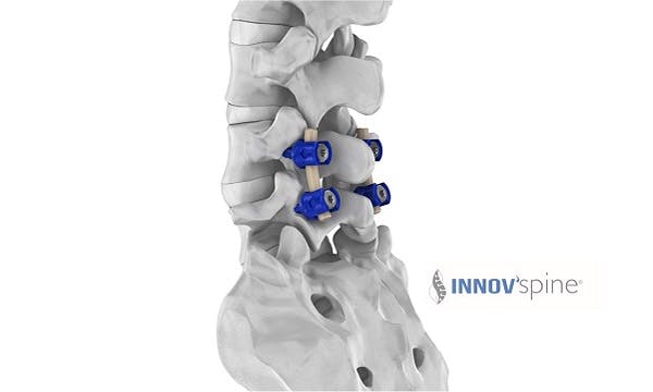 new spinal rods made of PEEK OPTIMA
