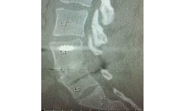 Solid Lumbar fusion at 6 months on CT scan