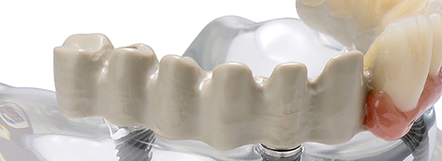 JUVORA dental implant 